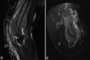 Isolated humeral metastasis in uterine cervical cancer: a rare entity